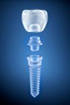 Zahnimplantat-System offen